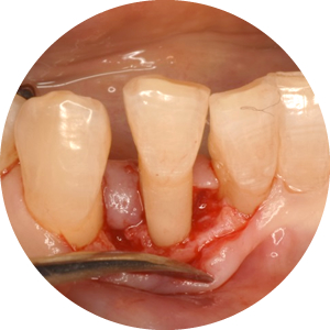 歯周外科処置　イメージ