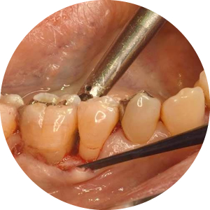 歯周再生療法　イメージ